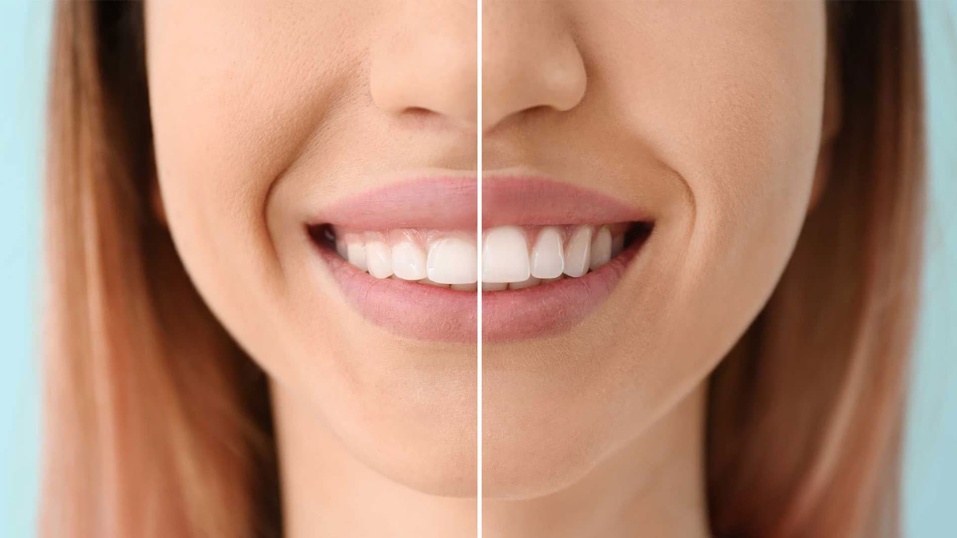 How Long Does Gum Contouring Take to Heal?