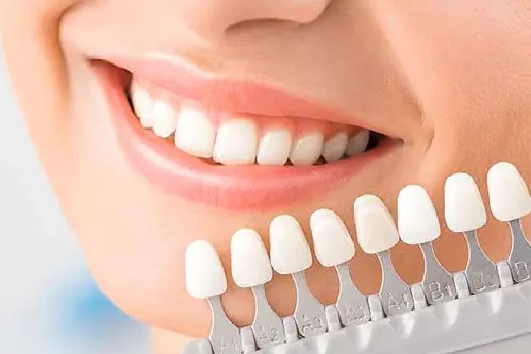 How Porcelain Veneers Can Transform Your Smile