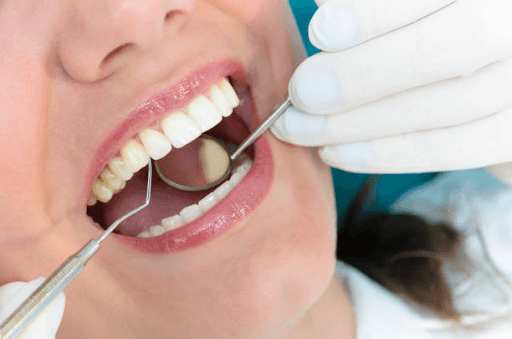 What is Gingivitis?